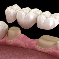 Digital illustration of a dental bridge