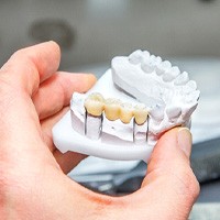 Dental bridge on a clay model