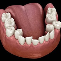 Illustration of crowded teeth