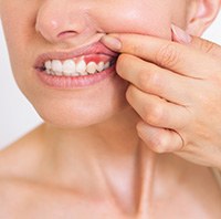 A woman revealing her inflamed gums