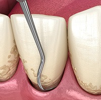 A 3D illustration of a scaling and root planing treatment