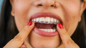 Close up of woman trying to insert ill-fitting Invisalign 